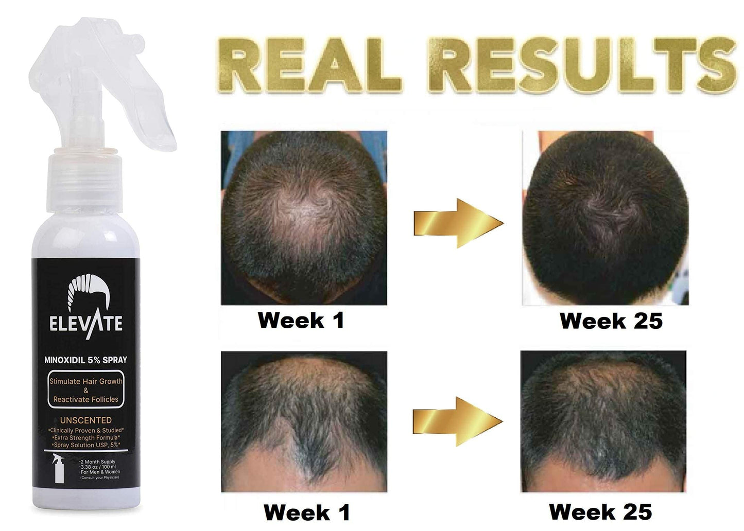 ELEVATE 5% Minoxidil Hair Growth Spray - Extra Strength Professional Treatment for Hair Loss and Regrowth - Stimulate Follicles for Men & Women - 1 to 2 Month Supply 100ml