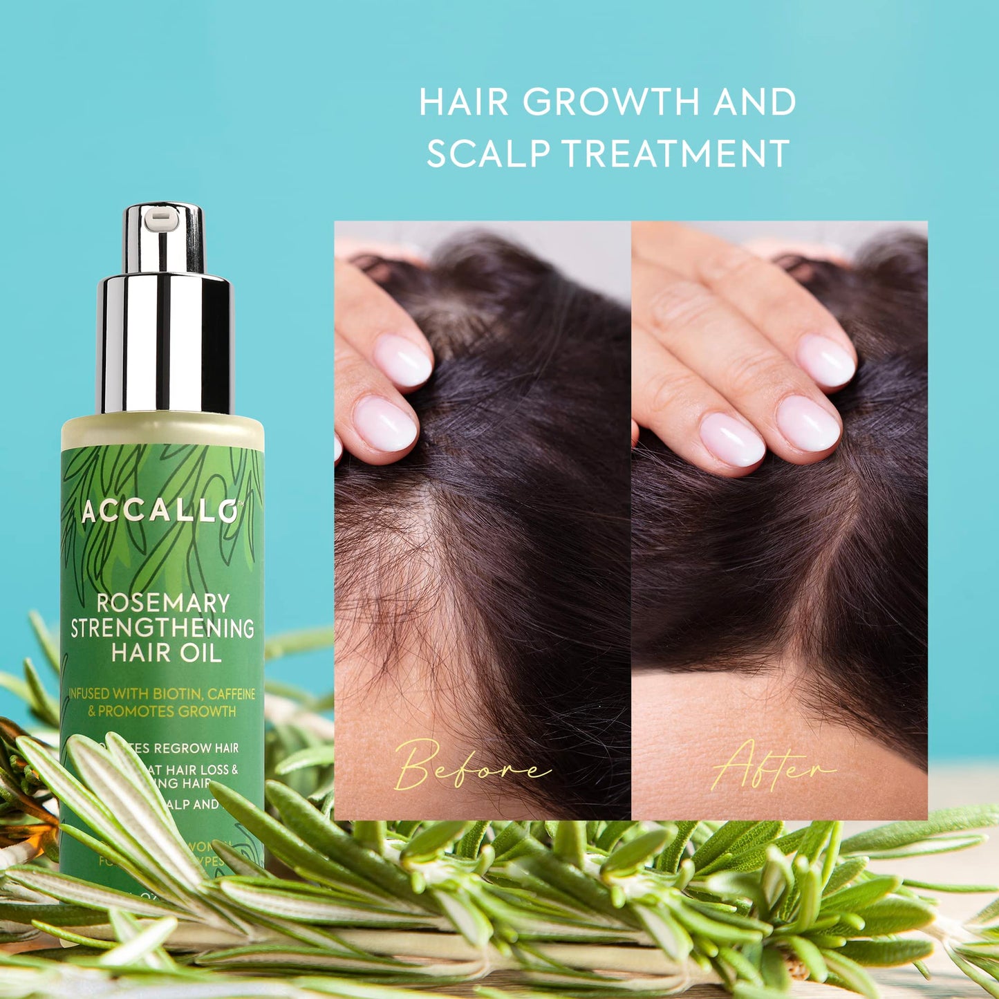 Accallo Hair Growth Oil, Caffeine Hair Growth, Scalp Oil Hair Growth, Rosemary Oil for Hair Growth, Hair Growth for Women, Hair Loss Treatments for Women, for Thicker & Stronger Hair, 2 FL OZ